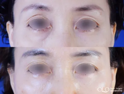 Before & After