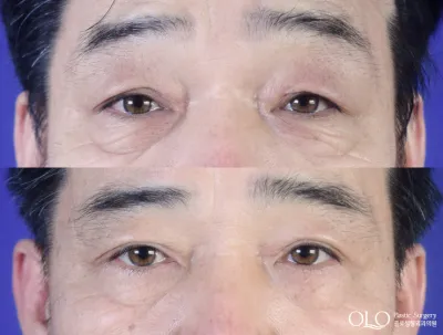 Before & After