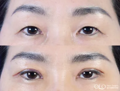 Before & After