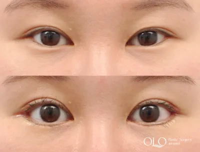 Before & After