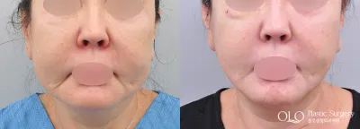 Before & After