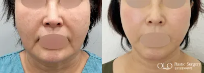 Before & After