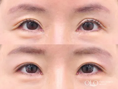 Before & After