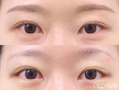 Before & After