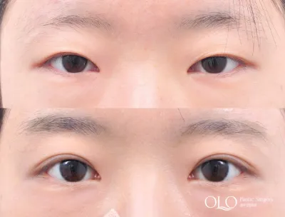 Before & After