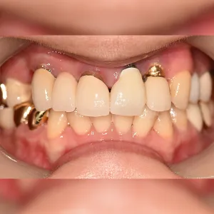 Before