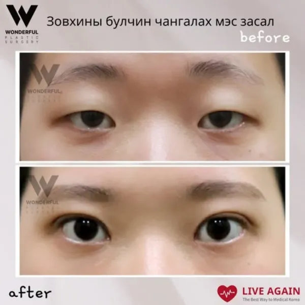 Зовхины булчин чангалах мэс засал