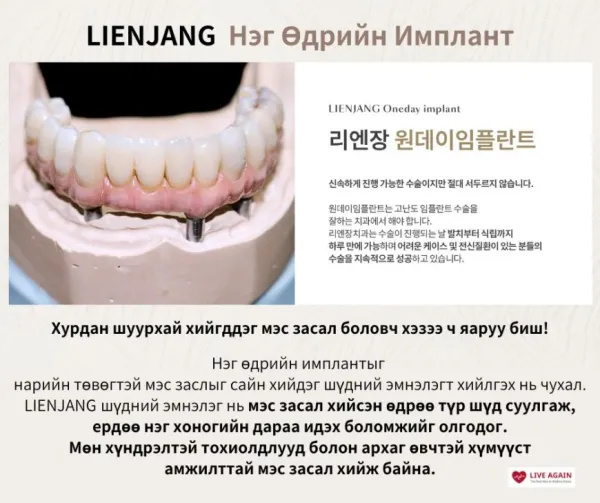 Нэг өдрийн имплант  "Lienjang шүдний эмнэлэг"