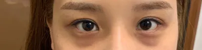 Нүдний доод өөх шилжүүлэн суулгах хагалгаа хийлгэлээ~ Сэтгэгдлээ оруулж байна~