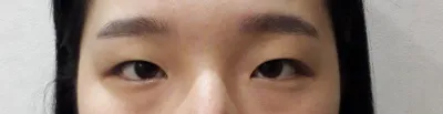 ♥Давхрааны хагалгааны сэтгэгдэл♥