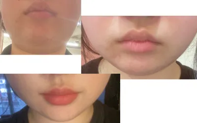 [** үйлчлүүлэгч] InMode+Beauty Fit тарианы эмчилгээний сэтгэгдэл