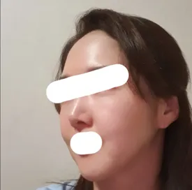 Лифтинг | Өөхний хагалгааны сэтгэгдэл