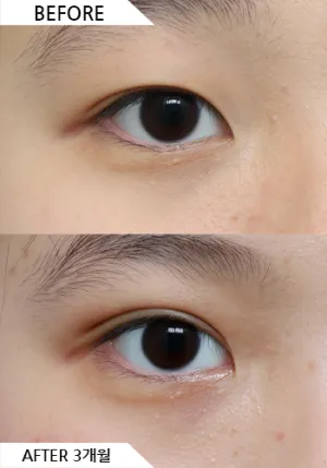 Before