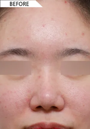 Before
