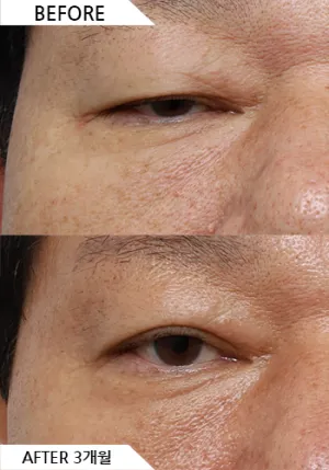 Before