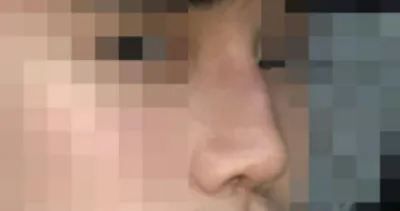 Хамрын нуруу, хамрын үзүүр, бөхөн, хамрын ясны жижигсгэл