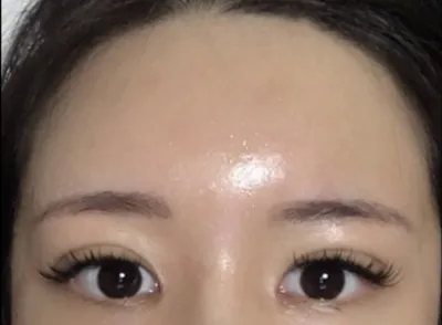 [Anti-Aging] Хо Рё Рён - Өөх шилжүүлэн суулгах, Нүд